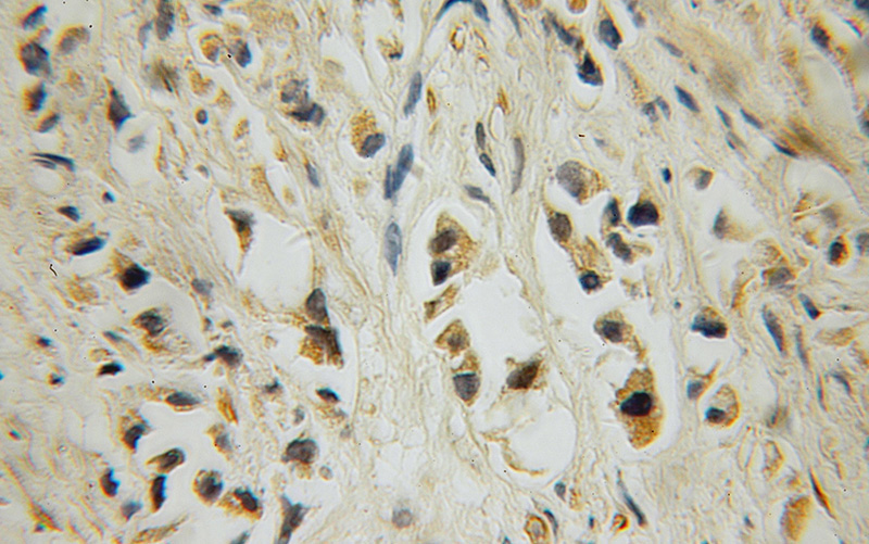 Immunohistochemical of paraffin-embedded human prostate cancer using Catalog No:107661(ALOX15B antibody) at dilution of 1:100 (under 10x lens)