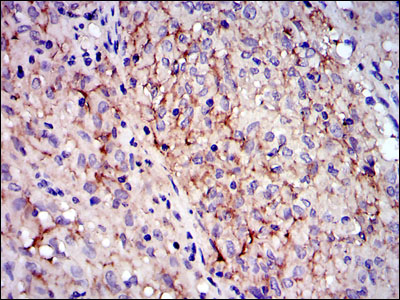 Immunohistochemical analysis of paraffin-embedded gastrointestinal stromal tumor using KIT mouse mAb with DAB staining.