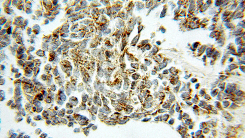 Immunohistochemical of paraffin-embedded human lung cancer using Catalog No:107742(ACO2 antibody) at dilution of 1:50 (under 10x lens)