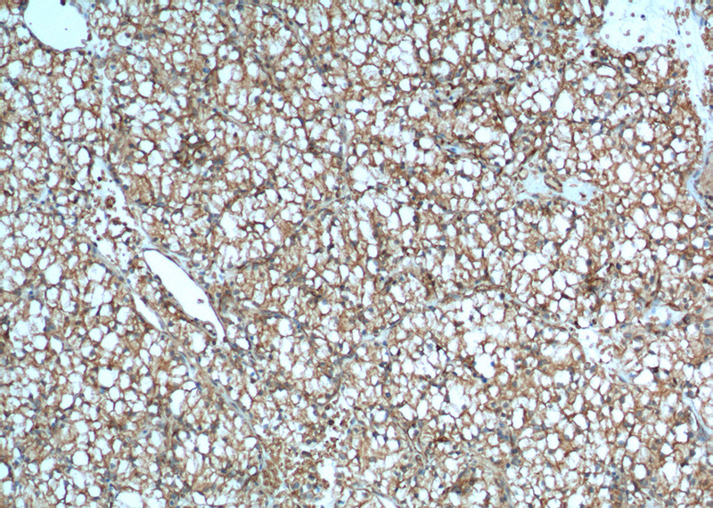 Immunohistochemistry of paraffin-embedded human renal cell carcinoma tissue slide using Catalog No:107030(CA9 Antibody) at dilution of 1:400 (under 10x lens). heat mediated antigen retrieved with Tris-EDTA buffer(pH9).