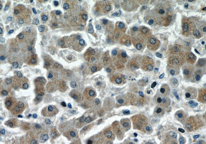Immunohistochemistry of paraffin-embedded human liver slide using Catalog No:113825(PHLPP Antibody) at dilution of 1:50