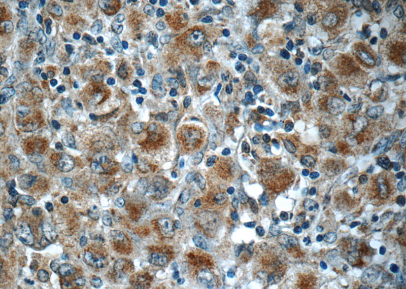 Immunohistochemistry of paraffin-embedded human lymphoma slide using Catalog No:114753(RNF213 Antibody) at dilution of 1:50
