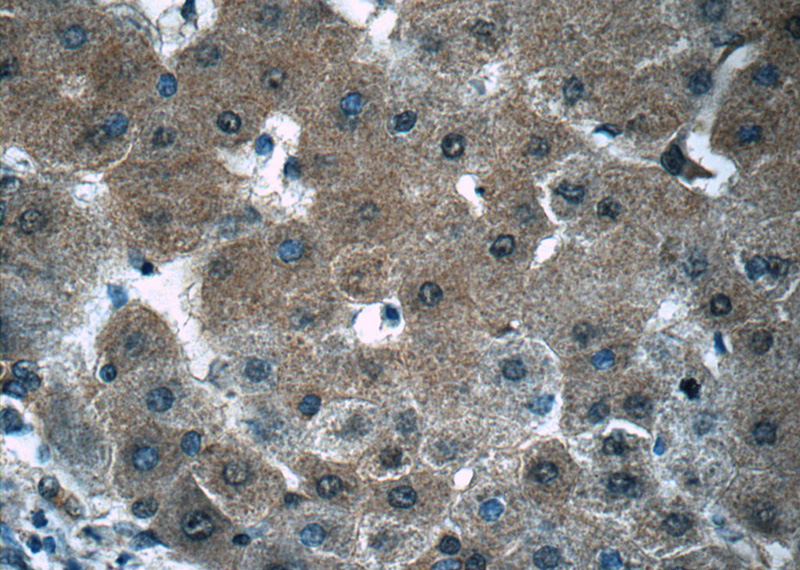 Immunohistochemistry of paraffin-embedded human hepatocirrhosis tissue slide using Catalog No:113784(PGK1 Antibody) at dilution of 1:50 (under 40x lens)