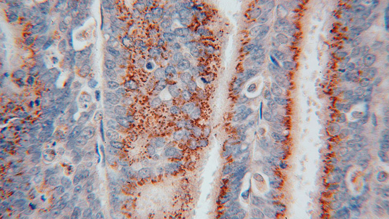 Immunohistochemical of paraffin-embedded human endometrial cancer using Catalog No:116885(YIPF4 antibody) at dilution of 1:50 (under 40x lens)