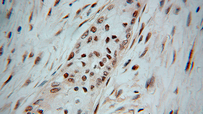 Immunohistochemical of paraffin-embedded human pancreas cancer using Catalog No:114618(RBM6 antibody) at dilution of 1:100 (under 40x lens)