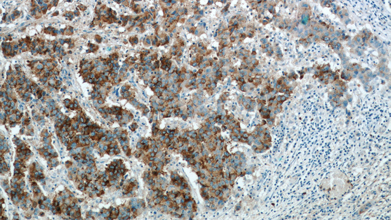 Immunohistochemical of paraffin-embedded human prostate cancer using Catalog No:107987(p504S,AMACR antibody) at dilution of 1:50 (under 10x lens). Heat mediated antigen retrieved with Citric acid buffer, pH6.0