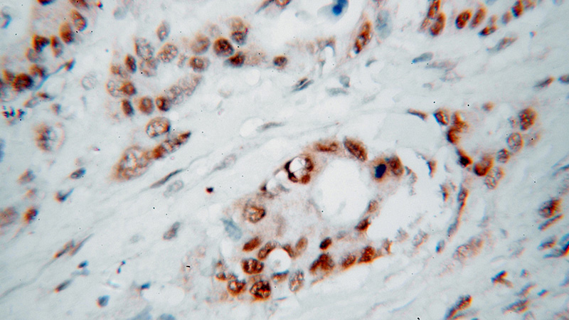 Immunohistochemical of paraffin-embedded human colon cancer using Catalog No:112867(MSH2 antibody) at dilution of 1:100 (under 40x lens)