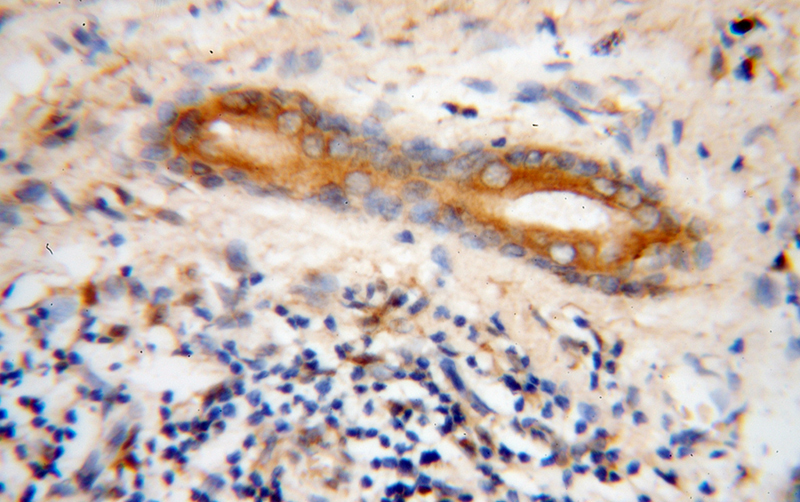 Immunohistochemical of paraffin-embedded human skin cancer using Catalog No:112651(MLPH antibody) at dilution of 1:50 (under 40x lens)