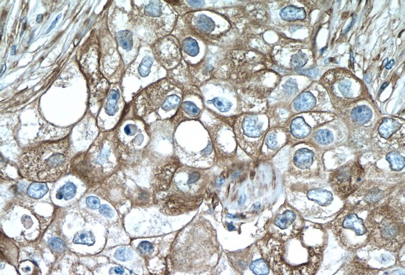 Immunohistochemistry of paraffin-embedded human breast cancer tissue slide using Catalog No:116288(TNF-a Antibody) at dilution of 1:50 (under 40x lens)