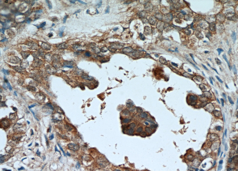 Immunohistochemical of paraffin-embedded human ovary tumor using Catalog No:107991(AMH antibody) at dilution of 1:25 (under 40x lens)