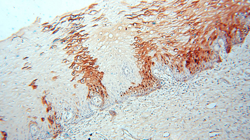 Immunohistochemical of paraffin-embedded human cervix using Catalog No:110439(FABP4 antibody) at dilution of 1:50 (under 10x lens)