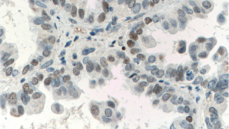 Immunohistochemistry of paraffin-embedded human ovary tumor tissue slide using Catalog No:107446(P53 Antibody) at dilution of 1:200 (under 40x lens). heat mediated antigen retrieved with Tris-EDTA buffer(pH9).