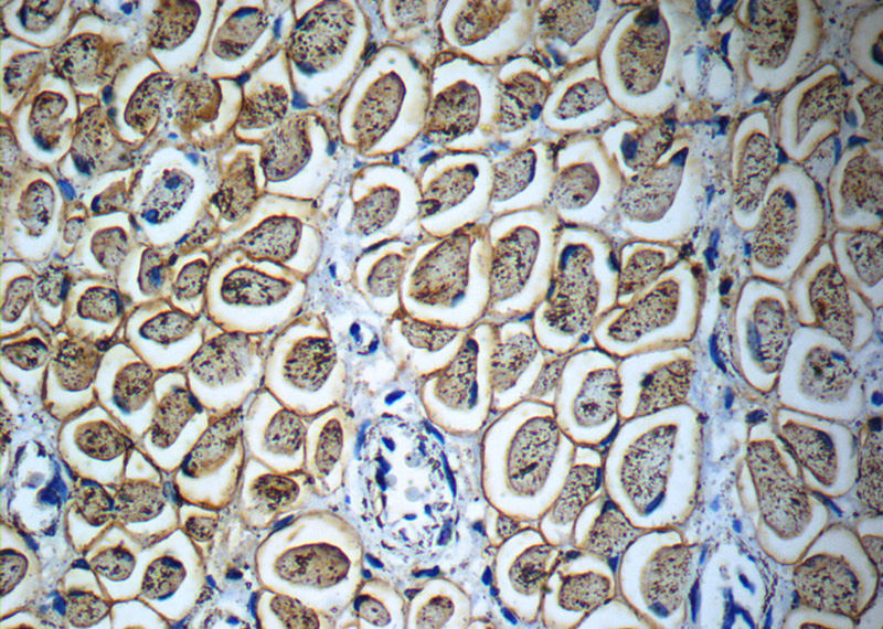 Immunohistochemistry of paraffin-embedded human osteosarcoma slide using Catalog No:113504(Osteocalcin Antibody) at dilution of 1:50