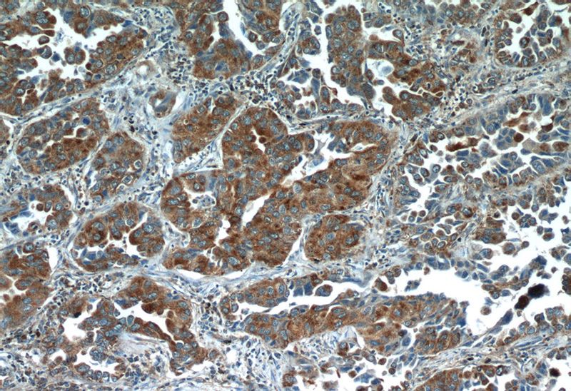 Immunohistochemistry of paraffin-embedded human lung cancer slide using Catalog No:116496(NPR2L,TUSC4 Antibody) at dilution of 1:50