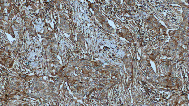 Immunohistochemistry of paraffin-embedded human breast cancer tissue slide using Catalog No:107188(CXCR7 Antibody) at dilution of 1:200 (under 10x lens). heat mediated antigen retrieved with Tris-EDTA buffer(pH9).
