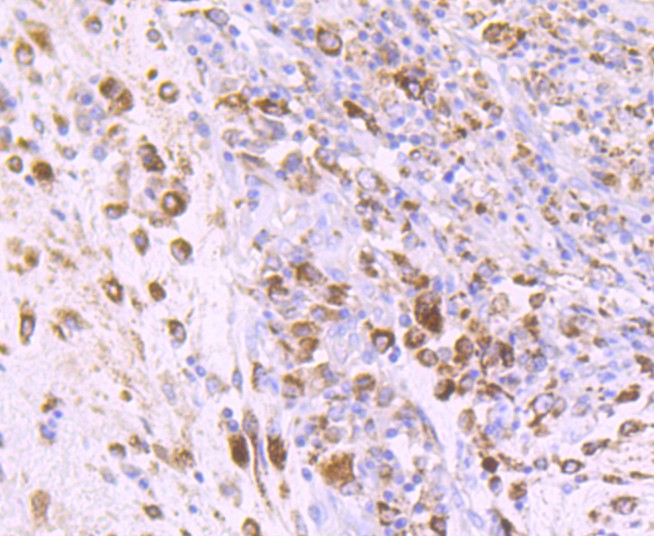 Fig7:; Immunohistochemical analysis of paraffin-embedded human colon carcinoma tissue using anti-IGF2 antibody. The section was pre-treated using heat mediated antigen retrieval with Tris-EDTA buffer (pH 9.0) for 20 minutes.The tissues were blocked in 1% BSA for 30 minutes at room temperature, washed with ddH; 2; O and PBS, and then probed with the primary antibody ( 1/50) for 30 minutes at room temperature. The detection was performed using an HRP conjugated compact polymer system. DAB was used as the chromogen. Tissues were counterstained with hematoxylin and mounted with DPX.