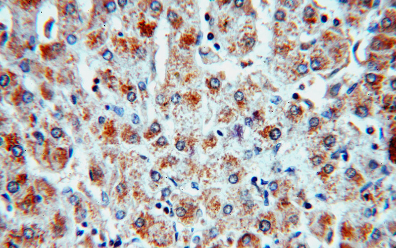 Immunohistochemical of paraffin-embedded human hepatocirrhosis using Catalog No:115826(SULT1A3 antibody) at dilution of 1:50 (under 40x lens)