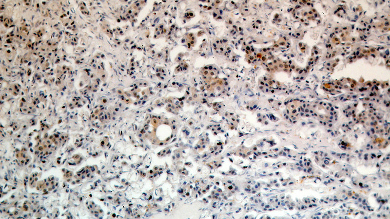 Immunohistochemical of paraffin-embedded human breast cancer using Catalog No:107075(B23 antibody) at dilution of 1:100 (under 10x lens)