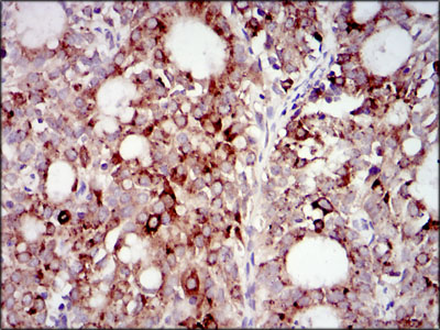 Immunohistochemical analysis of paraffin-embedded cervical cancer tissues using PIK3R1 mouse mAb with DAB staining.