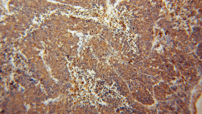 Immunohistochemical of paraffin-embedded human lung cancer using Catalog No:112938(Myh9 antibody) at dilution of 1:50 (under 10x lens)