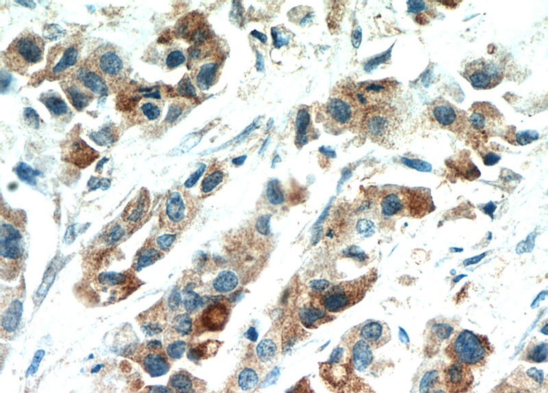 Immunohistochemical of paraffin-embedded human breast cancer using Catalog No:111765(IL17RB antibody) at dilution of 1:100 (under 40x lens)