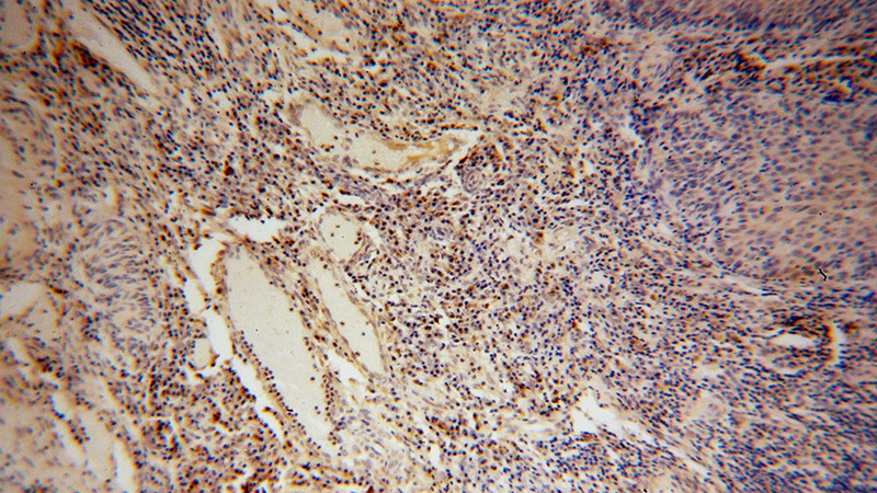 Immunohistochemical of paraffin-embedded human cervical cancer using Catalog No:117122(GS15 antibody) at dilution of 1:50 (under 10x lens)