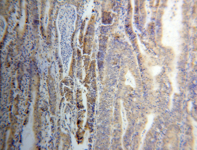 Immunohistochemical of paraffin-embedded human endometrial cancer using Catalog No:116043(THG1L antibody) at dilution of 1:100 (under 10x lens)