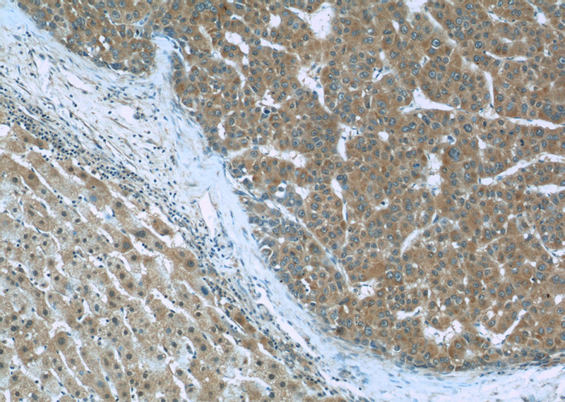 Immunohistochemistry of paraffin-embedded human liver cancer slide using Catalog No:107519(S100A6 Antibody) at dilution of 1:50