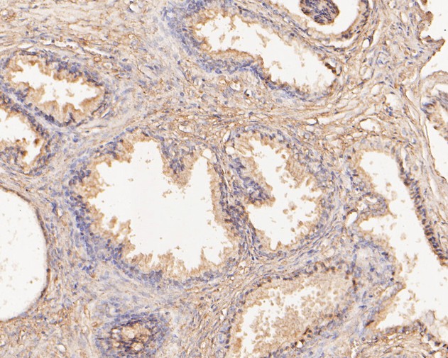 Fig3:; Immunohistochemical analysis of paraffin-embedded human prostate tissue using anti-SLFN12 antibody. The section was pre-treated using heat mediated antigen retrieval with Tris-EDTA buffer (pH 8.0-8.4) for 20 minutes.The tissues were blocked in 5% BSA for 30 minutes at room temperature, washed with ddH; 2; O and PBS, and then probed with the primary antibody ( 1/50) for 30 minutes at room temperature. The detection was performed using an HRP conjugated compact polymer system. DAB was used as the chromogen. Tissues were counterstained with hematoxylin and mounted with DPX.