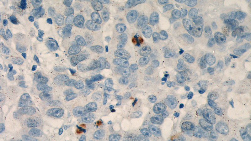 Immunohistochemistry of paraffin-embedded human prostate cancer tissue slide using Catalog No:116223(TPX2 Antibody) at dilution of 1:200 (under 40x lens). heat mediated antigen retrieved with Tris-EDTA buffer(pH9).