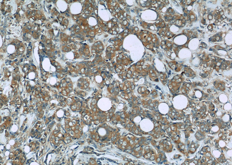 Immunohistochemistry of paraffin-embedded human breast cancer slide using Catalog No:114175(PRDX1 Antibody) at dilution of 1:50