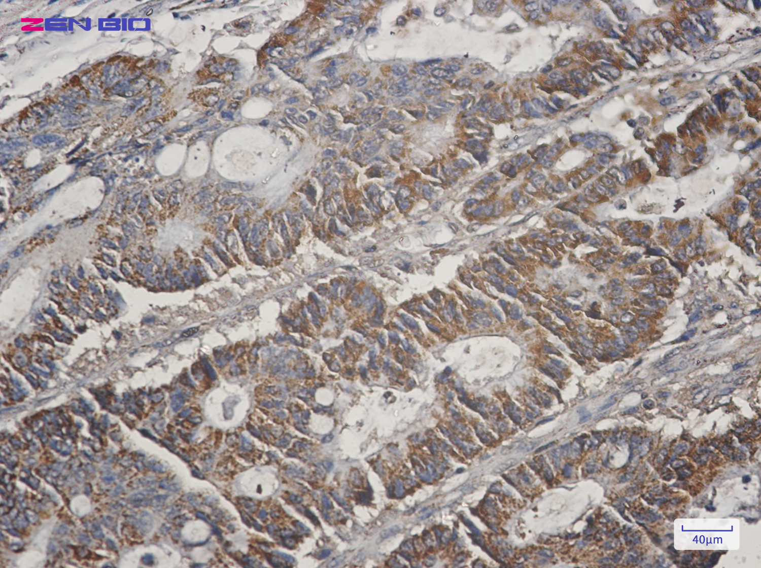 Immunohistochemistry of COX5B in paraffin-embedded Human colon cancer tissue using COX5B Rabbit pAb at dilution 1/50