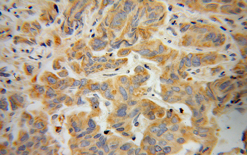 Immunohistochemical of paraffin-embedded human prostate cancer using Catalog No:113097(NEDD4L antibody) at dilution of 1:100 (under 40x lens)
