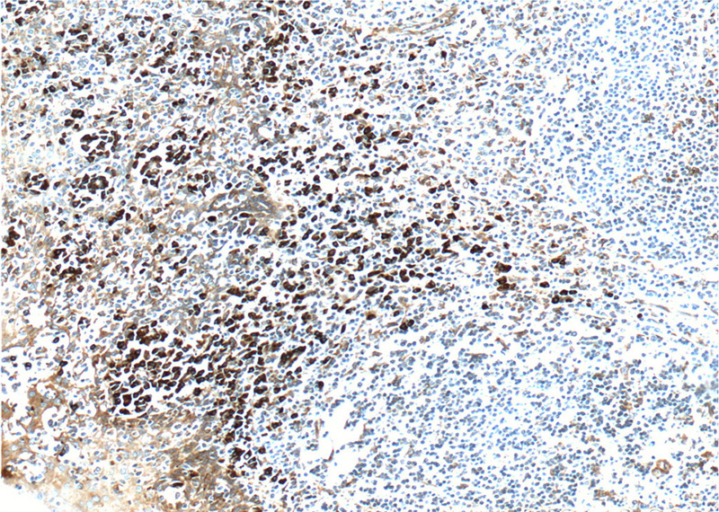 Immunohistochemistry of paraffin-embedded human tonsillitis tissue slide using Catalog No:111748(IL6 Antibody) at dilution of 1:200 (under 10x lens)