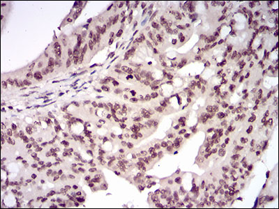 Immunohistochemical analysis of paraffin-embedded rectum cancer tissues using RELB mouse mAb with DAB staining.