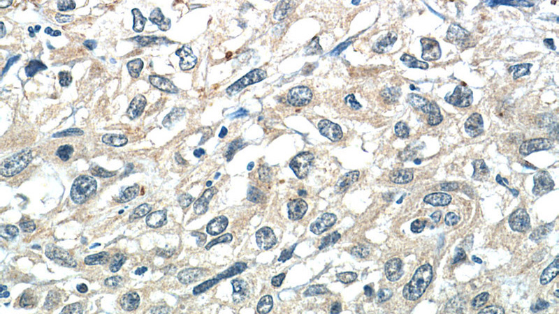 Immunohistochemistry of paraffin-embedded human cervical cancer tissue slide using Catalog No:108081(ANKRD55 Antibody) at dilution of 1:50 (under 40x lens)