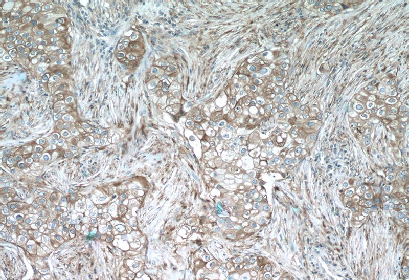 Immunohistochemistry of paraffin-embedded human breast cancer tissue slide using Catalog No:116288(TNF-a Antibody) at dilution of 1:50 (under 10x lens)