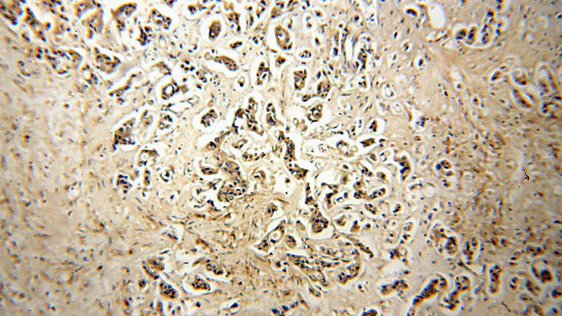 Immunohistochemical of paraffin-embedded human breast cancer using Catalog No:112263(LACRT antibody) at dilution of 1:50 (under 10x lens)