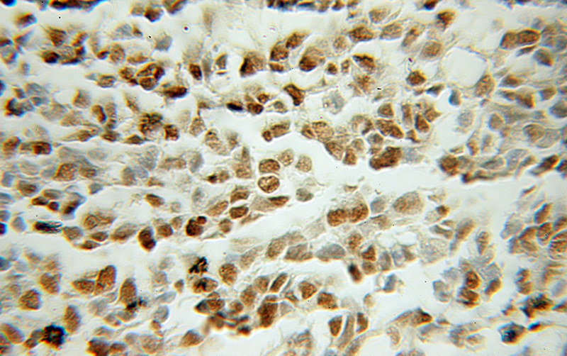 Immunohistochemical of paraffin-embedded human gliomas using Catalog No:114542(RANGAP1 antibody) at dilution of 1:100 (under 10x lens)