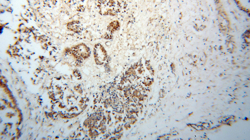Immunohistochemical of paraffin-embedded human breast cancer using Catalog No:114208(PRMT6 antibody) at dilution of 1:100 (under 10x lens)