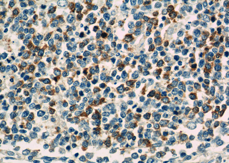 Immunohistochemistry of paraffin-embedded human tonsillitis tissue slide using Catalog No:116073(TLR3 Antibody) at dilution of 1:50 (under 40x lens)