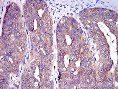 Immunohistochemical analysis of paraffin-embedded ovarian cancer tissues using C-CBL mouse mAb with DAB staining.