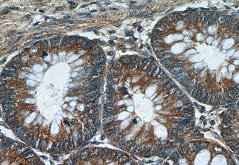 Immunohistochemistry of paraffin-embedded human colon tissue slide using Catalog No:112315(LRCH2 Antibody) at dilution of 1:50 (under 40x lens)