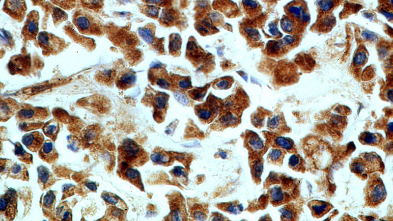 Immunohistochemical of paraffin-embedded human breast cancer using Catalog No:110660(FBRS antibody) at dilution of 1:50 (under 40x lens)