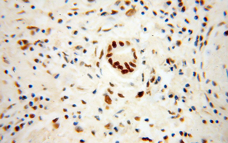 Immunohistochemical of paraffin-embedded human colon cancer using Catalog No:114248(PSME3 antibody) at dilution of 1:50 (under 40x lens)