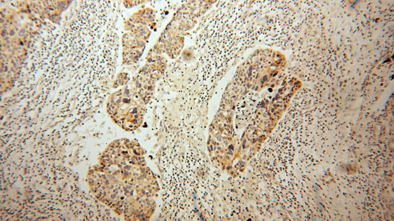 Immunohistochemical of paraffin-embedded human ovary tumor using Catalog No:112829(MRPL45 antibody) at dilution of 1:100 (under 10x lens)