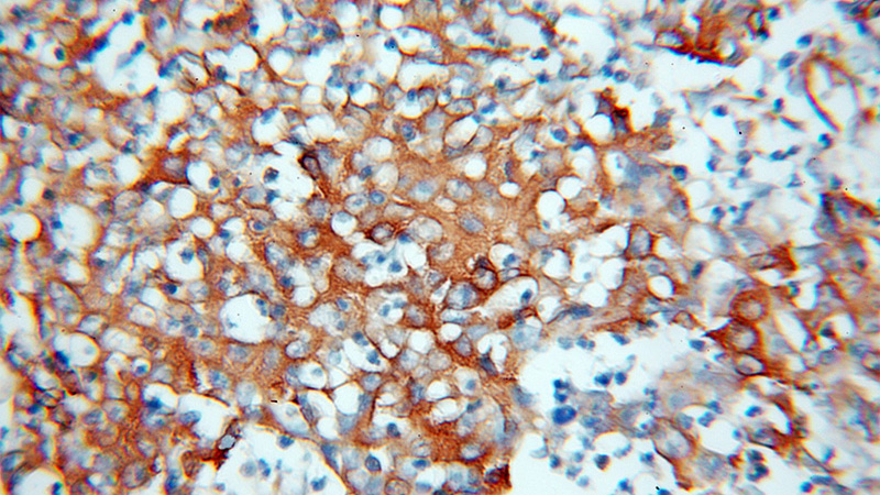 Immunohistochemical of paraffin-embedded human colon cancer using Catalog No:114905(RPLP0 antibody) at dilution of 1:100 (under 10x lens)