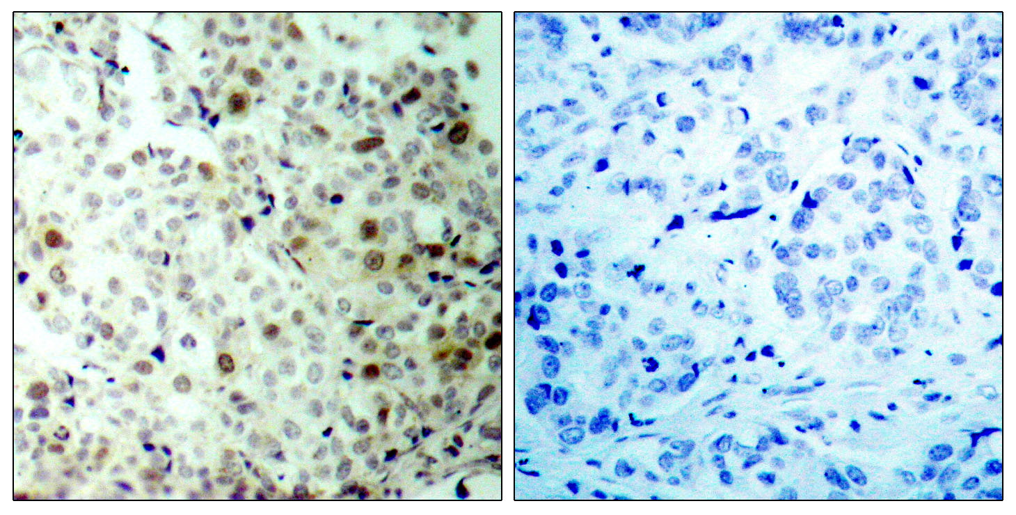 Immunohistochemical analysis of paraffin-embedded human breast carcinoma tissue using CDK2 (Phospho-Thr160) Antibody (left) or the same antibody preincubated with blocking peptide (right).