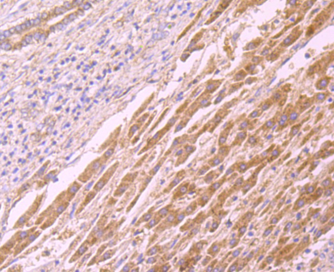Fig8: Immunohistochemical analysis of paraffin-embedded human liver cancer tissue using anti-CD137 antibody. Counter stained with hematoxylin.