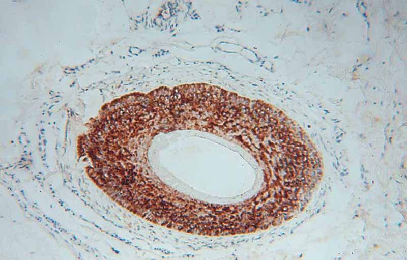 Immunohistochemical of paraffin-embedded human skin cancer using Catalog No:113926(PLA2G4D antibody) at dilution of 1:50 (under 10x lens)